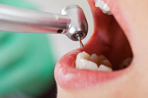 Best Emergency Tooth Extraction in Antelope, CA